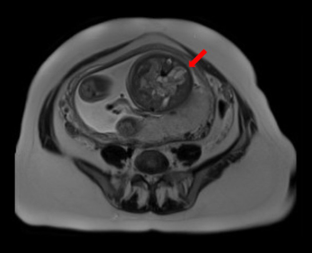 Prenatal MRI image showing a solid and cystic retroperitoneal mass with associated calcifications.
