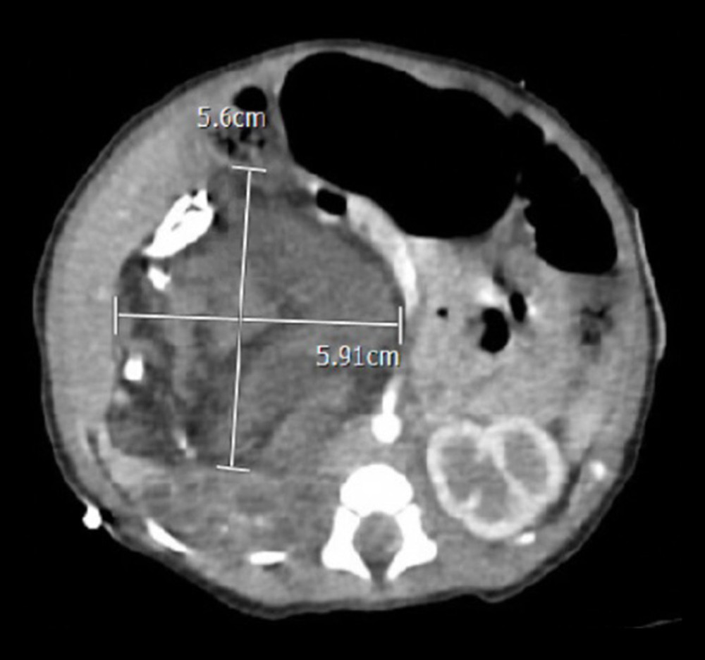 Post-natal computerized tomography (CT) images demonstrating a right retroperitoneal mass with soft tissue, fat, and calcifications and regional mass effect.