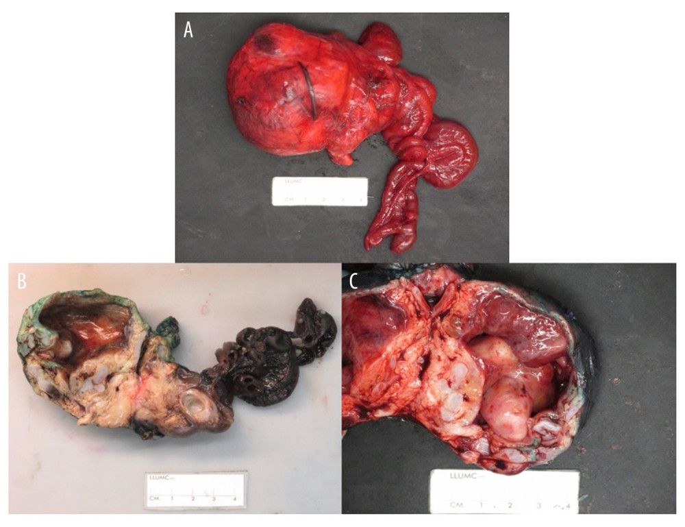 Intraoperative findings of right retroperitoneal mass with adjacent well-formed yet discontinuous and vermiform bowel segments. External surface of resected mass (A), and cross-sections of the mass revealing a unilocular cyst with multiple sessile masses and irregular cartilaginous and cystic lesions filled with mucoid material (B, C).
