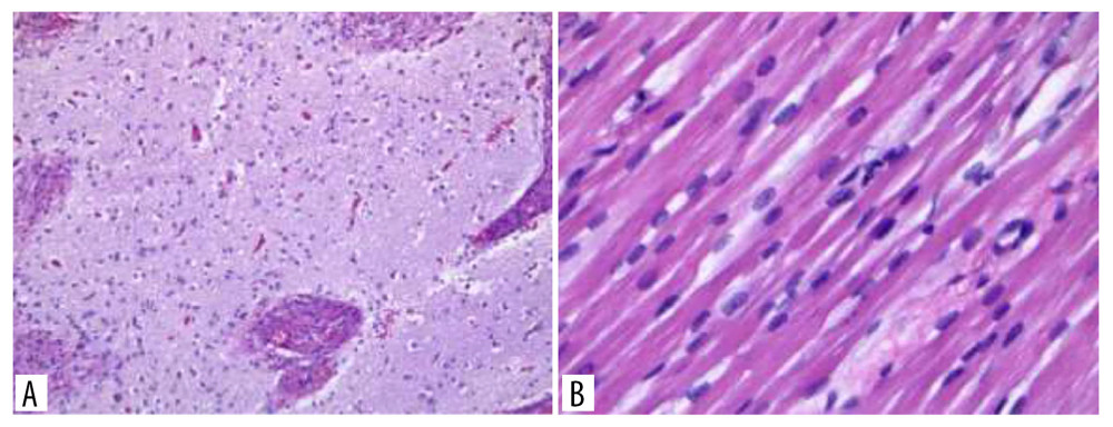 Pathologic examination of right retroperitoneal mass, with hematoxylin eosin staining demonstrating malformed brain parenchyma (A) and striated cardiac musculature (B).