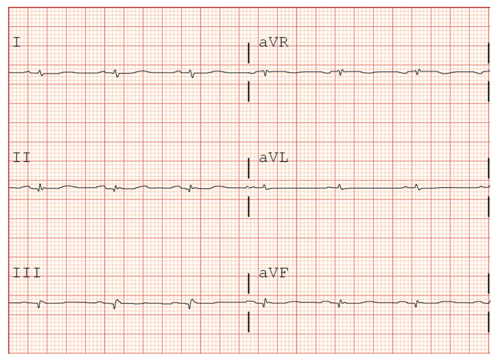 Electrocardiogram (ECG) showing low-voltage QRS complexes in the limb leads (I, II, III, aVR, aVL, and aVF). ECG speed of 25 mm/s.