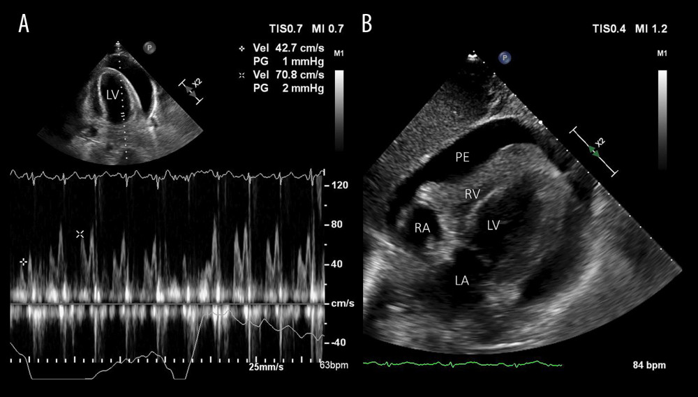 (A) An apical four-chamber pulsed-wave Doppler transthoracic echocardiogram recording of mitral valve inflow velocities varying abnormally/excessively with respiration suggesting ventricular interdependence and (B) an image from the subcostal view showing right ventricular inversion, both showing a large circumferential pericardial effusion with elements consistent with cardiac tamponade physiology. LA – left atrium; LV – left ventricle; PE – pericardial effusion; RA – right atrium; RV – right ventricle.