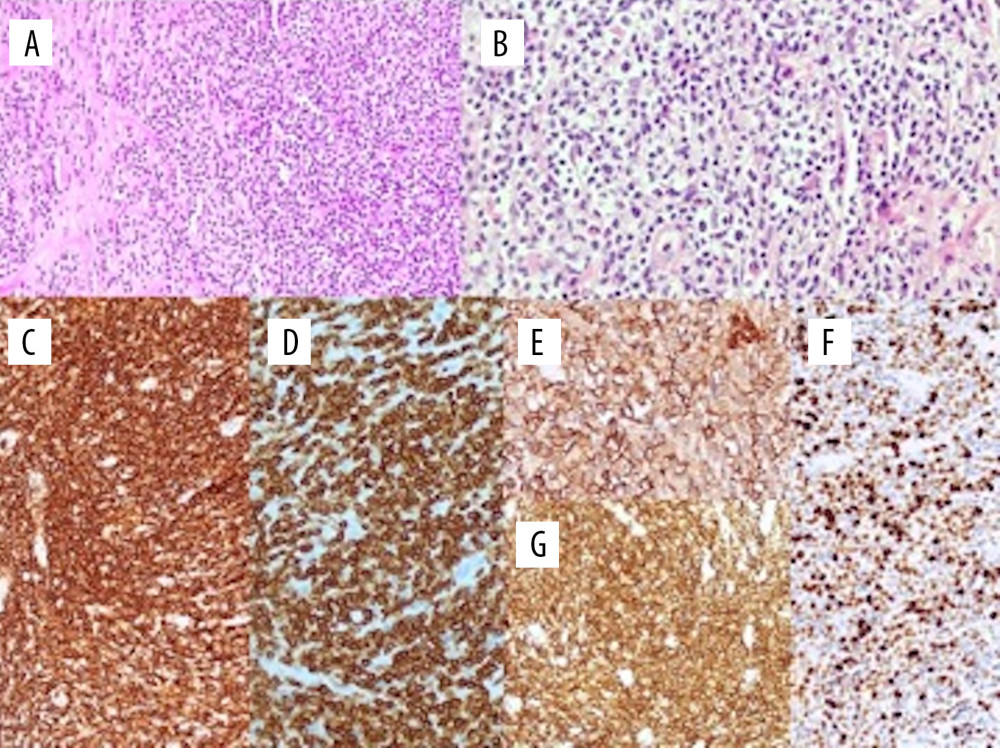 Histological photomicrographs for the peripheral follicular helper T-cell phenotype (breast): (A) A population of small atypical lymphocytes with a diffuse growth pattern, admixed eosinophils are present (hematoxylin and eosin stain, low magnification ×20) (B) The lymphocytes showed clear cytoplasm and dark nuclei with irregular profiles and small nucleoli. Eosinophils are also evident (hematoxylin and eosin stain, high magnification ×40). (C) Immunohistochemical stains showed a T-cell phenotype: CD5 (magnification ×10). (D) Immunohistochemical stains showed a T-cell phenotype: CD3 (magnification ×20). (E) Helper T-cell markers were present in the T-cell population as revealed by strong PD1 (magnification ×10). (F) Immunohistochemical stains showed a T-cell phenotype: CD4 (magnification ×4). (G) Proliferation index Ki67 60% to 70% (magnification ×10).
