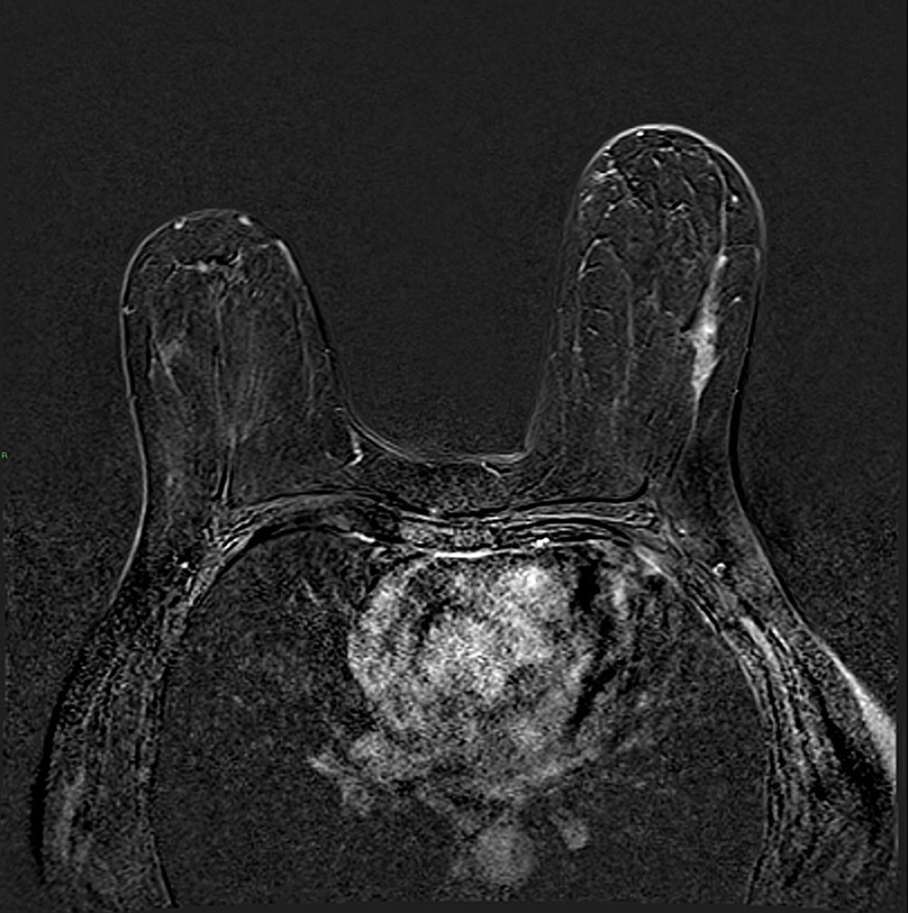Appearance of the ductal carcinoma in situ on magnetic resonance imaging (MRI). The axial digital subtraction dynamic (MRI) sequence afteran intravenous gadolinium injection showed a 33-mm non-mass contrast enhancement characterized by a regional enhancement distribution in the lower external quadrant of the left breast.