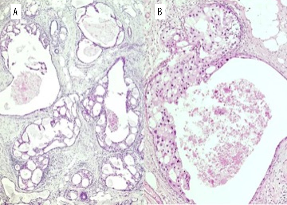 Histological photomicrographs of the ductal carcinoma in situ. (A) A cluster of ducts with atypical ductal hyperplasia and low-grade ductal carcinoma in situ with a micropapillary and cribriform growth pattern (hematoxylin and eosin stain, low magnification ×4). (B) Ducts of the low-grade ductal carcinoma in situ, with apocrine differentiation and central comedonecrosis (hematoxylin and eosin stain, high magnification ×20).