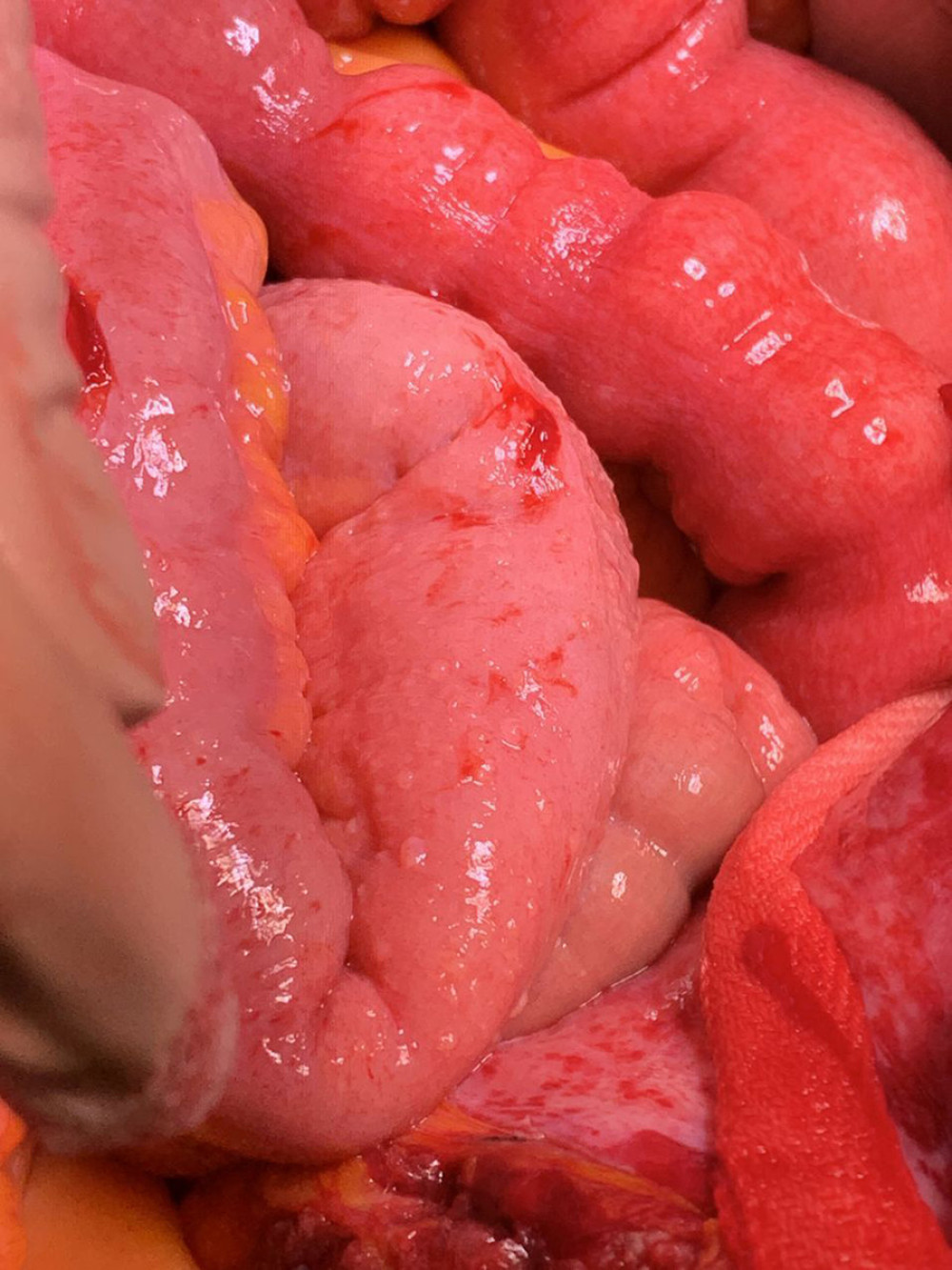 Multiple sub-centimetric grayish nodules on visceral and parietal peritoneum during abdominal evaluation.