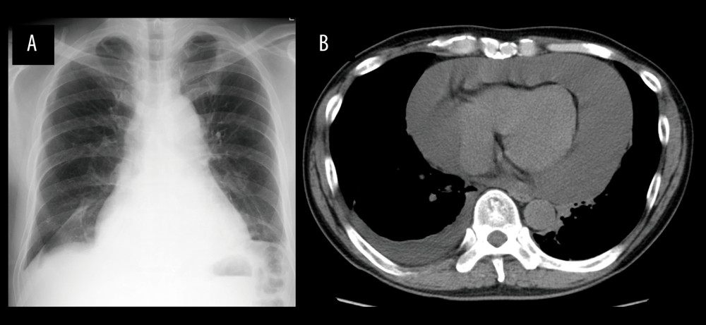 (A) Chest X-ray examination shows cardiomegaly. (B) Computed tomography examination shows massive pericardial effusion with a tumorous region in the pericardial space.