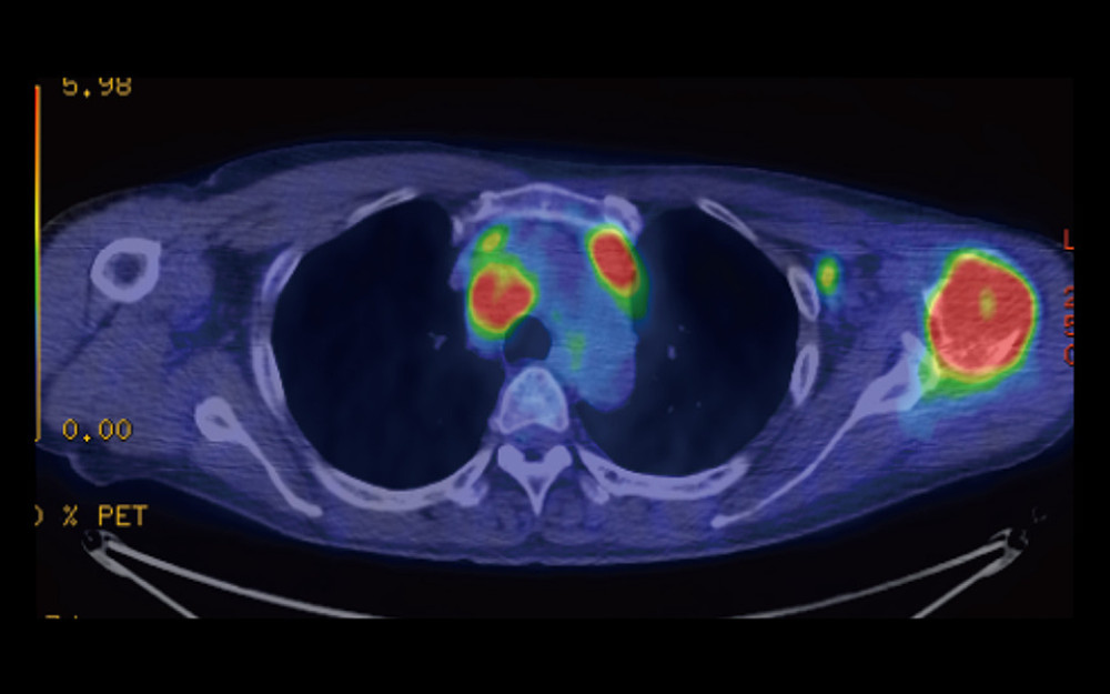 A representative axial image of 18F-fluorodeoxyglucose-positron emission tomography (FDG-PET) shows increased uptake of FDG in multiple lesions, including those in the left proximal humerus and mediastinal lymph nodes.