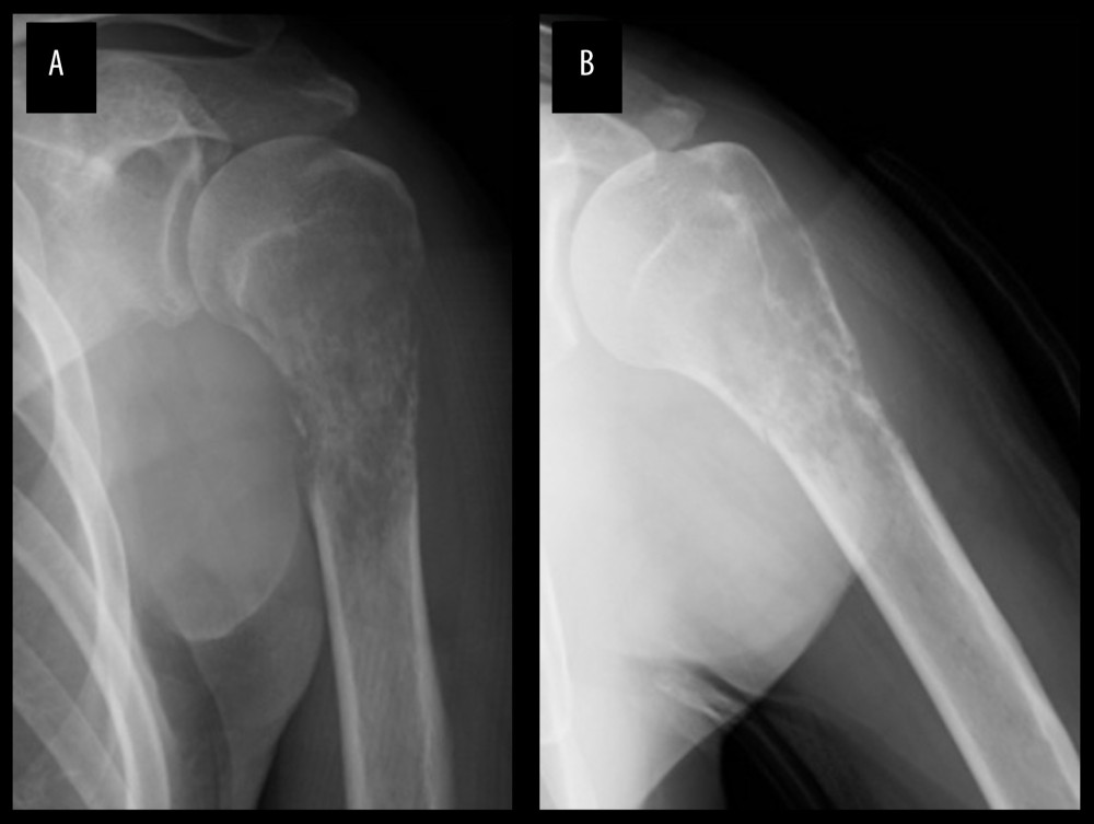 (A) Anteroposterior and (B) lateral views on plain X-ray show an osteolytic lesion in the left proximal humerus.