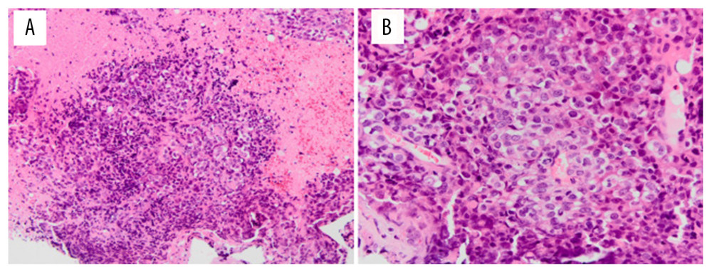 Microscopic images of the tumor specimen (hematoxylin and eosin staining). (A) Low-power magnification, showing sheets of a compact proliferation of tumor cells with necrotic areas. (B) A compact proliferation of atypical small-round cells in a high-power magnification.