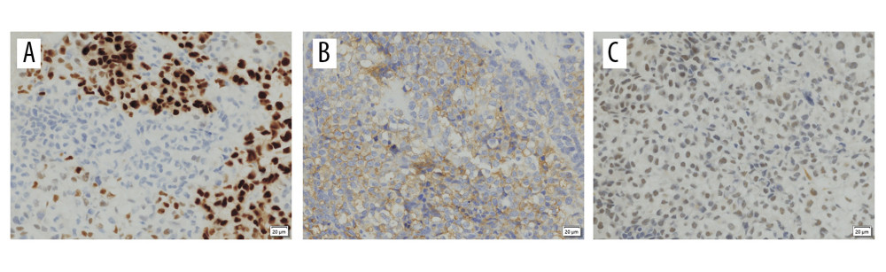 Immunohistochemical detection of (A) WT1, (B) CD99, and (C) CIC.