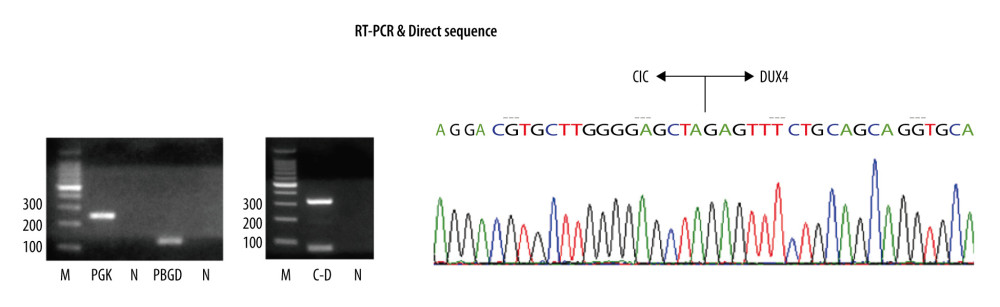 Reverse transcription-polymerase chain reaction (left and middle images) and subsequent direct sequence (right image), showing a transcript of the CIC-DUX4 fusion identified. (M – size marker; PGK – phosphoglycerate kinase; PBGD – porphobilinogen deaminase; C–D – CIC-DUX4; N – negative control).