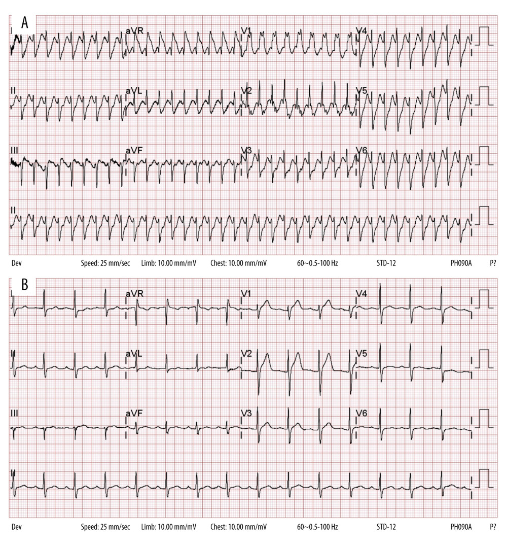 The electrocardiogram (ECG) during the wide QRS tachycardia (cycle length: 275 msec) with typical right bundle branch block pattern on admission (A). ECG during sinus rhythm showed delayed AV conduction (PR interval: 220 msec) and subtle intraventricular conduction delay (QRS duration: 104 msec) (B).