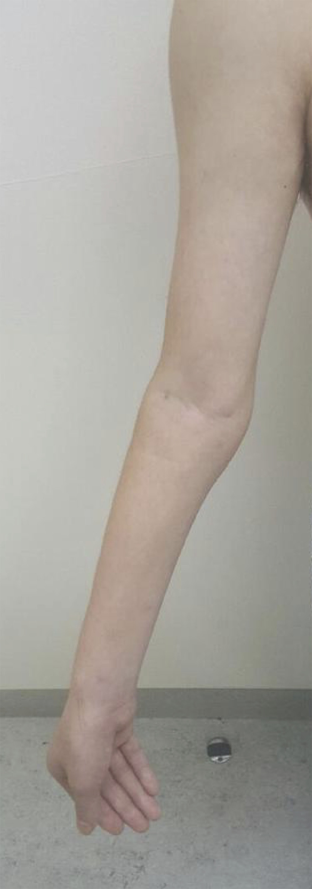 Clinical features of the patient. Distal muscle atrophy was noted in the upper extremity.