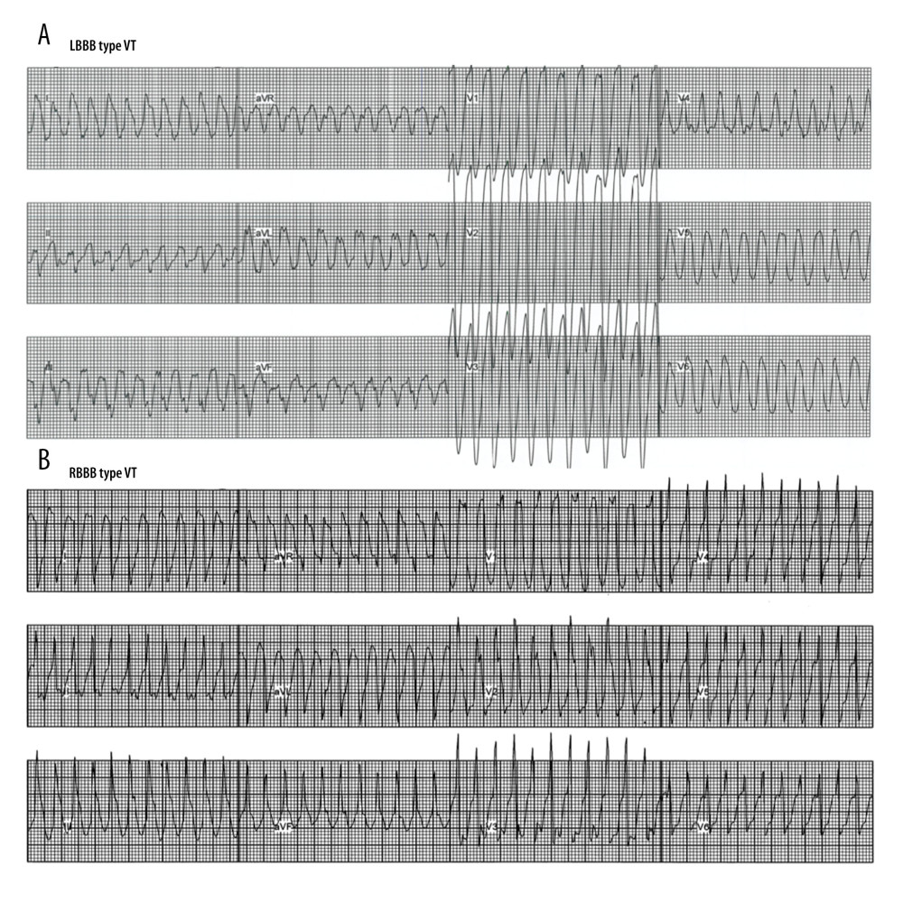 Induced tachycardia during initial (A) electrophysiologic study (EPS) and repeated EPS (B). Wide QRS tachycardia with left bundle branch block (BBB) pattern was induced with ventricular electrical stimulation. Tachycardia cycle length (TCL) was 216 msec (A). The other form of ventricular tachycardia with right BBB morphology with TCL of 228 msec (B).