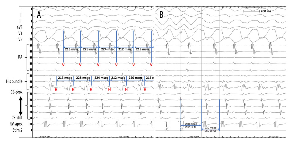 The intracardiac recording showing the activation sequence in the right atrium (RA), coronary sinus (CS-prox~CS-dist), His bundle, and right ventricle (RV apex). During wide QRS tachycardia with left bundle branch block pattern, the H-V relationship was 1: 1 with constant H-V intervals and V-V intervals were dependent on H-H intervals (A). Post-pacing interval – tachycardia cycle length was 28 msec at the RV (B).