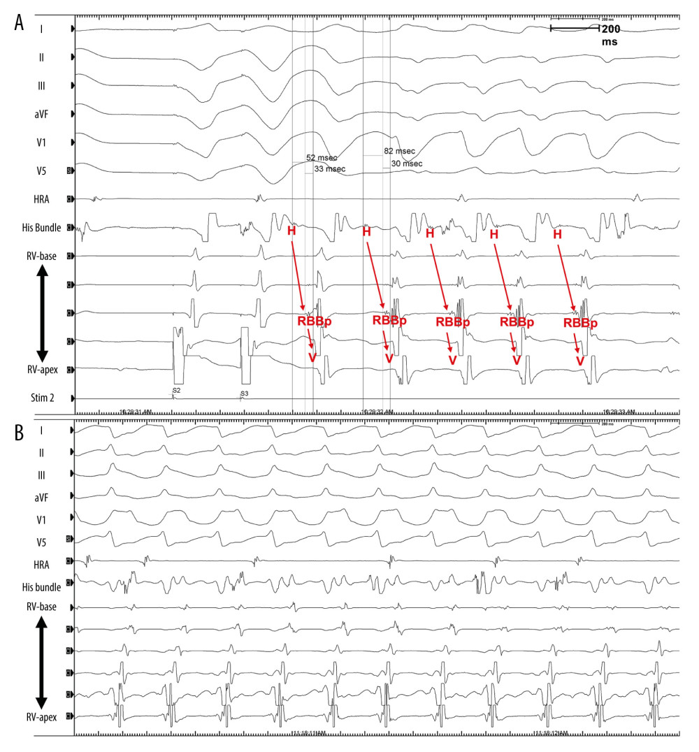 The intracardiac recording showing the activation sequences during ventricular tachycardia (VT) with left bundle branch block pattern. RV activation was preceded by His bundle and right bundle branch (A). Intracardiac tracing during VT with right bundle branch block (B). HRA – high right atrium; RBBp – right bundle branch potential; RV – right ventricle; V – ventricular activation; H – his bundle activation.