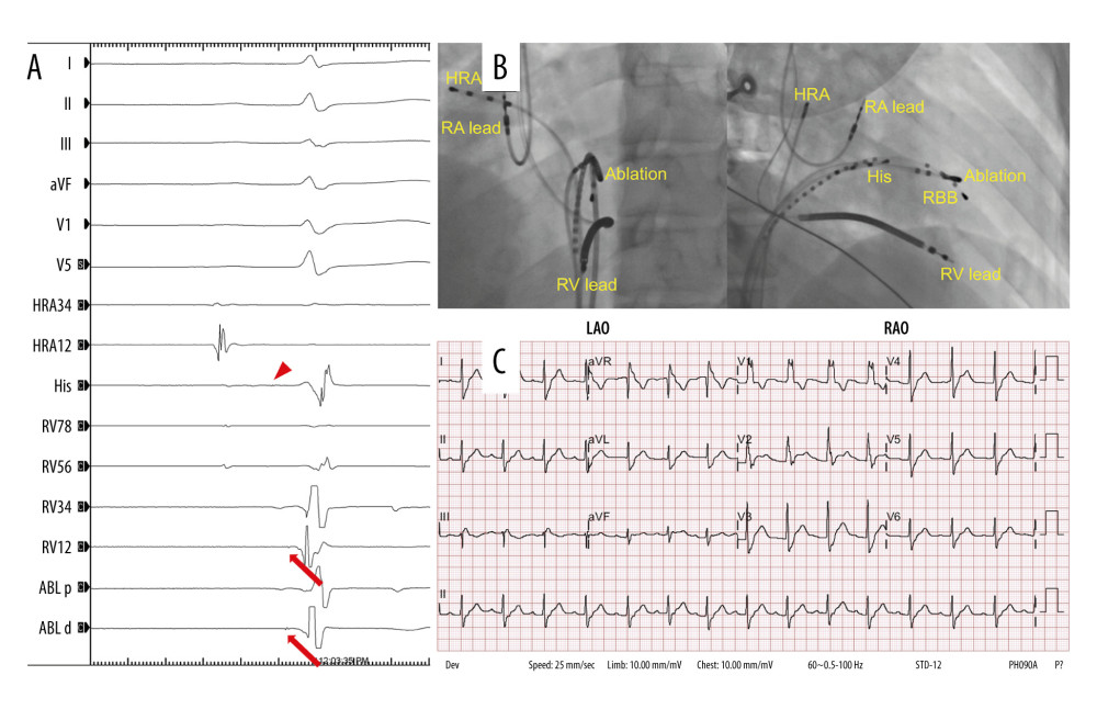 Right bundle branch potentials (arrows) were recorded in the intracardiac tracing of the ablation catheter (ABLp and ABLd). Tiny His bundle potential was recorded in the His catheter (arrowhead) (A). Fluoroscopic image showing the location of multipolar electrode catheters and ablation catheter (B). Post-ablation ECG showed complete right bundle branch block (C). HRA – high right atrium; RBB – right bundle branch; RV – right ventricle.