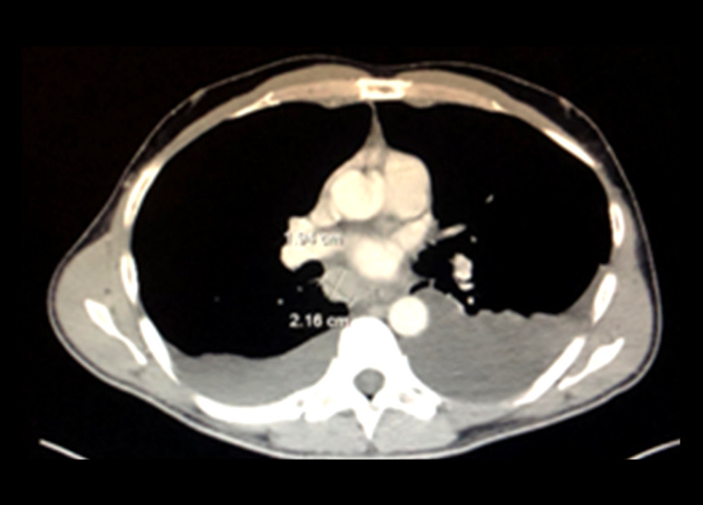Computed tomography scan of the chest. The size of the heart is within normal limits. Moderately small bilateral pleural effusions are visible, which are larger on the left than on the right side. The right hilar lymph node measures 2.2×1.9 cm.