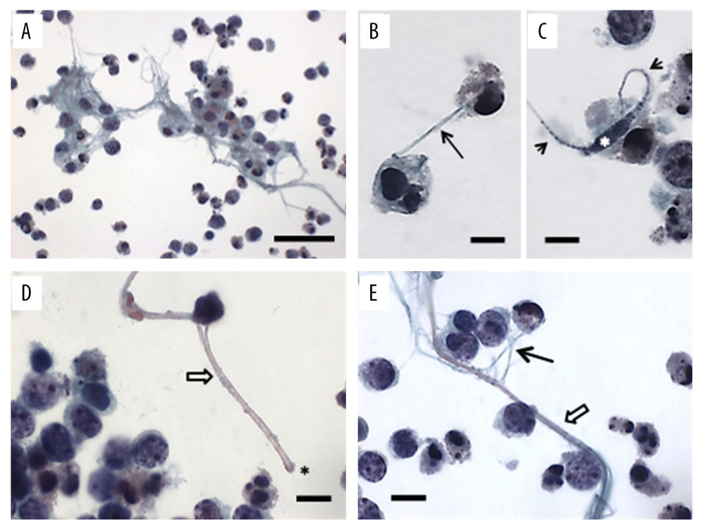 A pleural fluid sample. (A) A cluster of atypical lymphocytes. The cells have distinct nuclear bodies and a high nucleus-to-cytoplasm ratio. From these cells originates a net of filaments (filopodia-like filaments) that reach and trap surrounding cells (scale bar=50 µm). (B) A nanotube-like filament connects 2 atypical lymphocytes (arrow). Small particles of intensely-stained material are present in the cytoplasm as well as at the periphery of the nucleus and close to the cell membrane (scale bar=5 µm). (C) Densely-stained material similar to nuclear chromatin (white asterisk) is seen in the cytoplasm of atypical lymphocytes. The material gives rise to 2 thin tubes containing small particles of condensed material (short arrows), which probably were created when the main mass fragmented (scale bar=5 µm). (D, E) Unusually long, large-caliber cylindrical fibers (white arrows), many with truncated ends (asterisk in D), are seen in the pleural fluid. The black arrow points to the filopodia-like filaments (scale bar=10 µm).