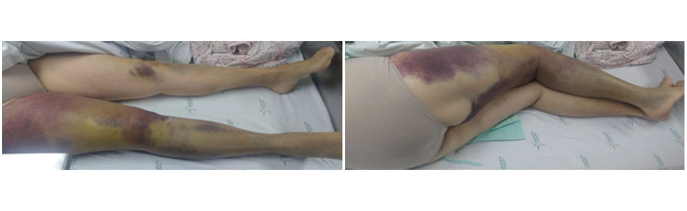 Ecchymoses and hematomas in lower limbs.