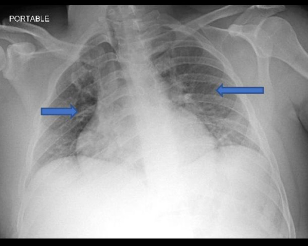 Blue arrows showed bilateral infiltrates consistent with pulmonary edema.