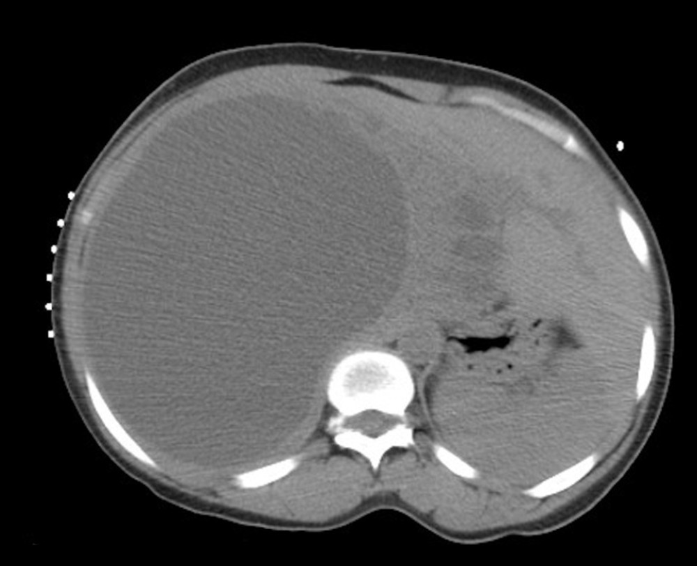 Computed tomography scan of hepatic cyst.