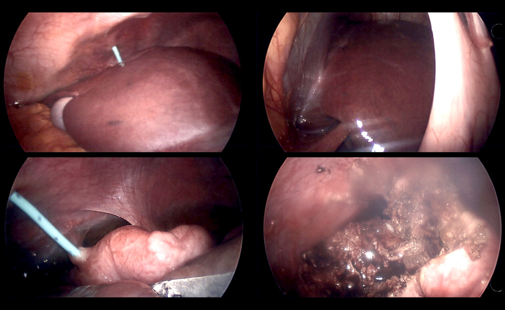 Intra-abdominal laparoscopic view of lateral right lobe of liver metastatic ameloblastoma and cystic drainage.