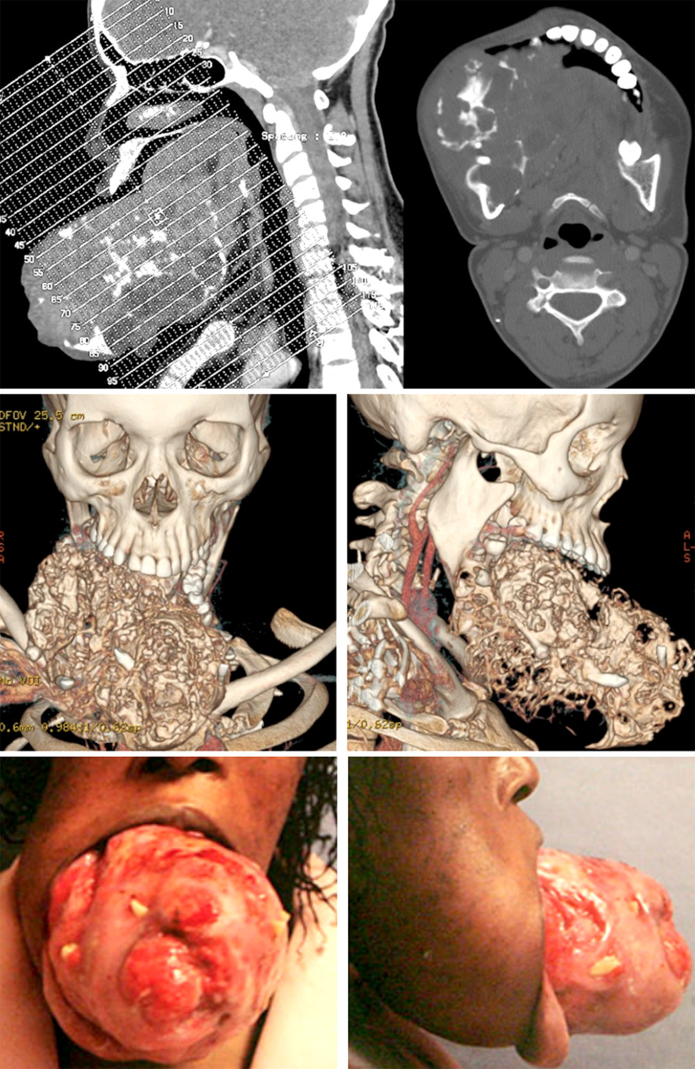 Computed tomography imaging of primary ameloblastoma with measurement and 3-dimensional reconstruction.