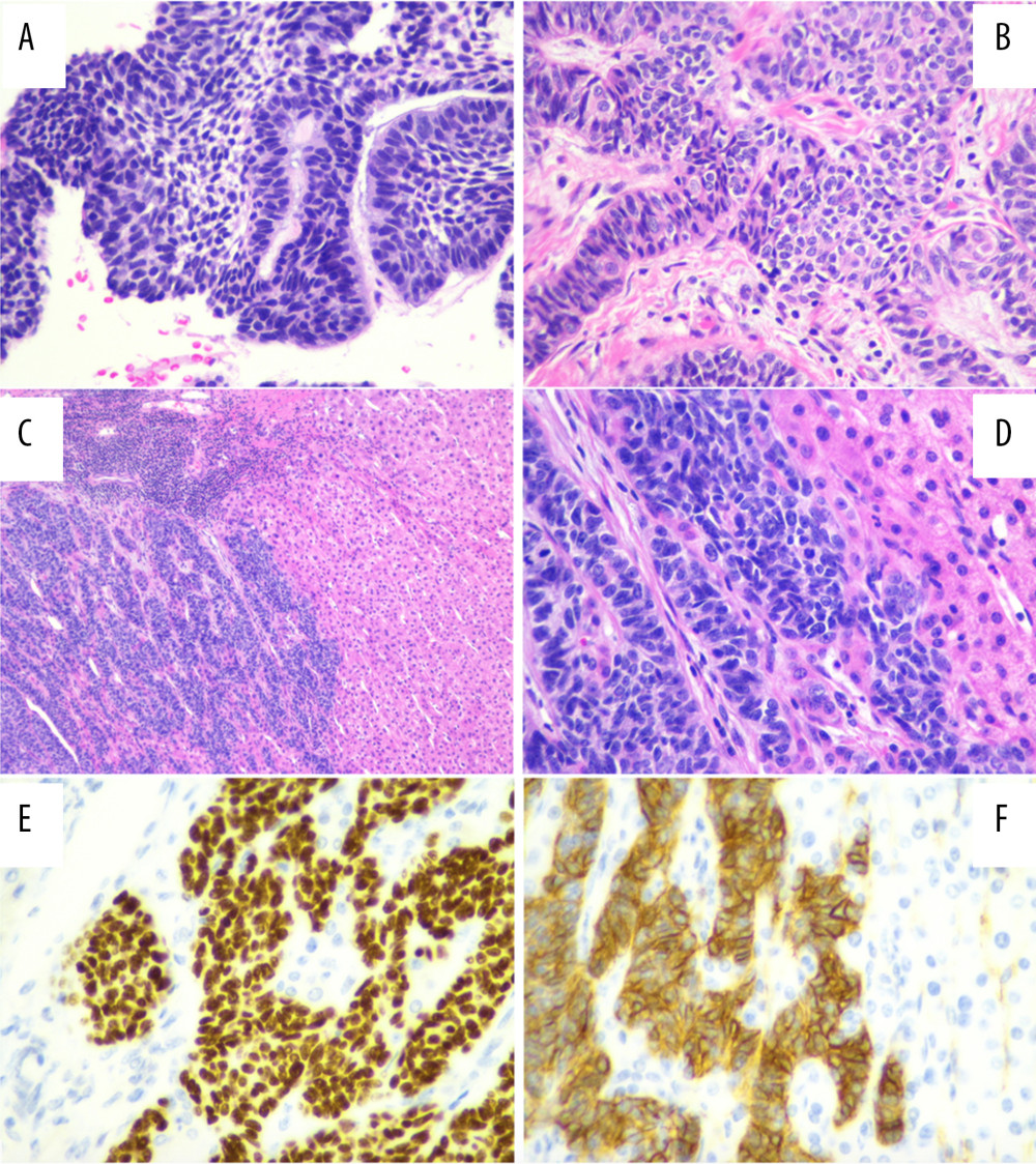 Histology images of ameloblastoma. (A) Floor of mouth mass (400×). (B) Mandible mass (400×). (C) Hepatic ameloblastoma metastasis (100×). (D) Hepatic ameloblastoma metastasis (400×). (E) Hepatic mass positive CK 5/6 staining (400×). (F) Hepatic mass positive P63 staining (400×).