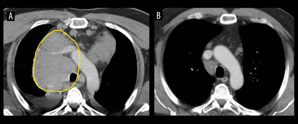 (A) Chest computed tomography (CT) scan with contrast (axial view) showing a large mass measuring up to 8.4×7.3×8.3 cm (yellow circle) in the right paratracheal region, causing significant compression to the superior vena cava. (B) Chest CT scan after chemotherapy showing marked improvement of the mediastinal and right hilar adenopathy.