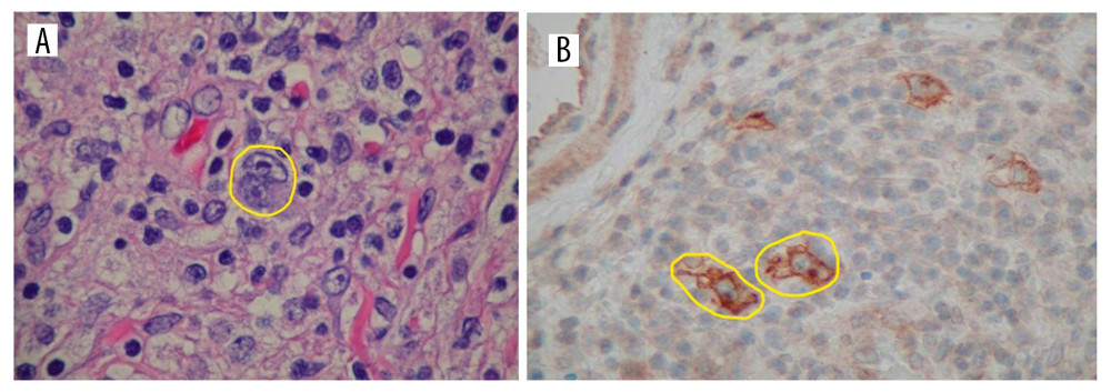 (A) Hematoxylin and eosin staining of the tumor showing Reed-Sternberg cells (yellow circle). (B) Immunohistochemical stain of the tumor showing CD30+ cells (yellow circle).