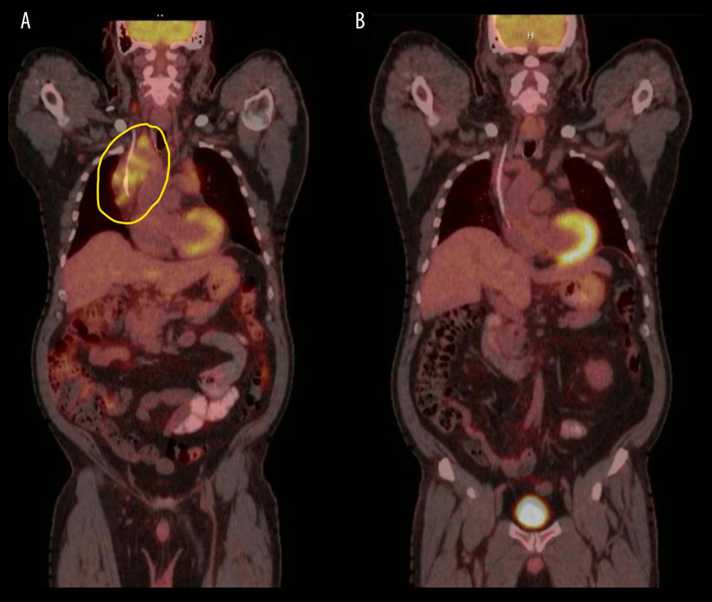(A) Positron emission tomography/computed tomography (PET/CT) before chemotherapy showing intense metabolically active mass (yellow circle) compressing the superior vena cava. (B) PET/CT in month 6 showing the decreased size of the right paratracheal mass hat has become metabolically inactive (standardized uptake value=2.73).