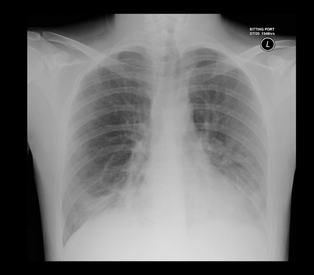 Patient’s initial chest X-ray showing airspace opacity in the right-lower zone.