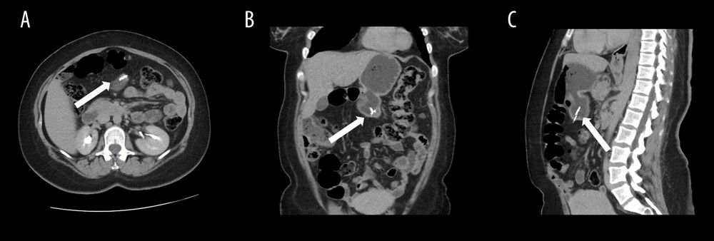 A CT scan of the abdomen and pelvis showing a metallic density (arrows). (A) Axial section. (B) Coronal section. (C) Sagittal section.