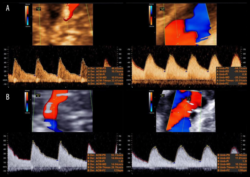 Doppler ultrasound showing diamniotic dichorionic pregnancy. It is important to note that the middle cerebral artery and the umbilical artery have normal values of pulsatility index and flow present in diastole, which translates into adequate transplacental flow. (A) twin 1; (B) twin 2.