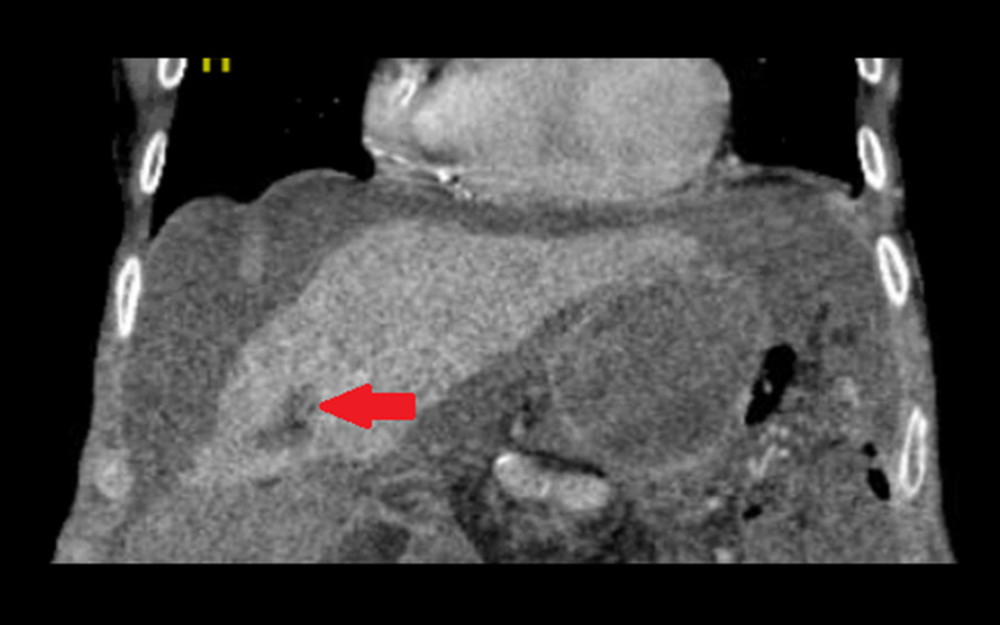 Computerized tomography scan of abdomen and pelvis showing the tumor in the right lobe of the liver.