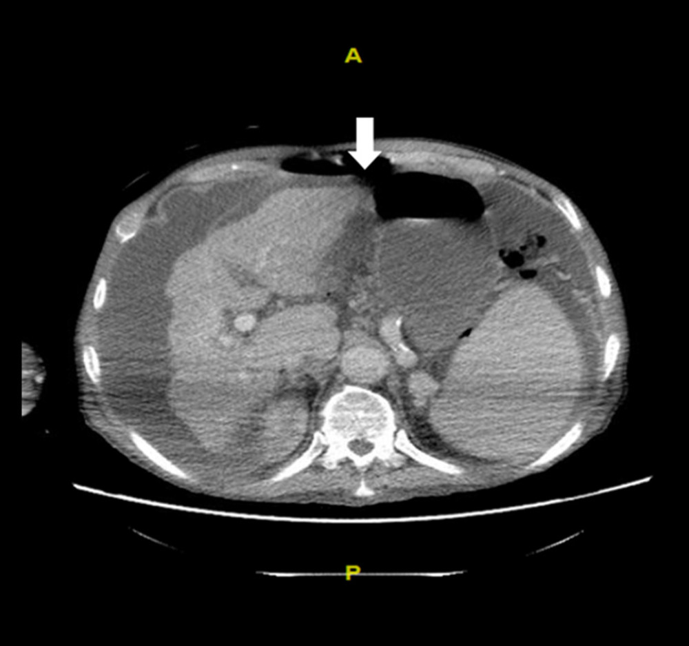 Computerized tomography scan of abdomen and pelvis with contrast material consistent with pneumoperitoneum and cirrhotic liver.