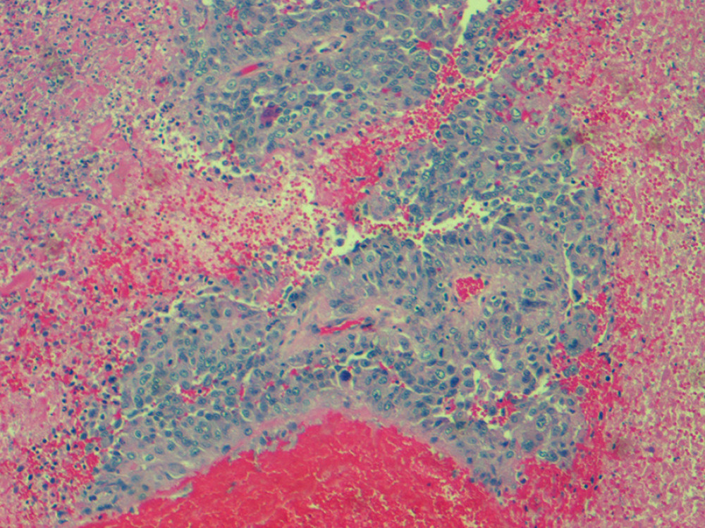 Histopathology showing a nest of tumor cells invading the liver parenchyma (hematoxylin and eosin stain, magnification ×40).