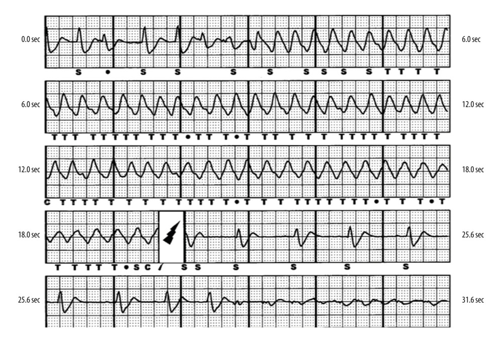 Representative episode of appropriate ICD therapy for VT/VF. MMVT is initiated by repetitive unifocal PVCs. While the shock successfully converted the MMVT, the patient went into VF 7 s later (not initiated by the same PVC).
