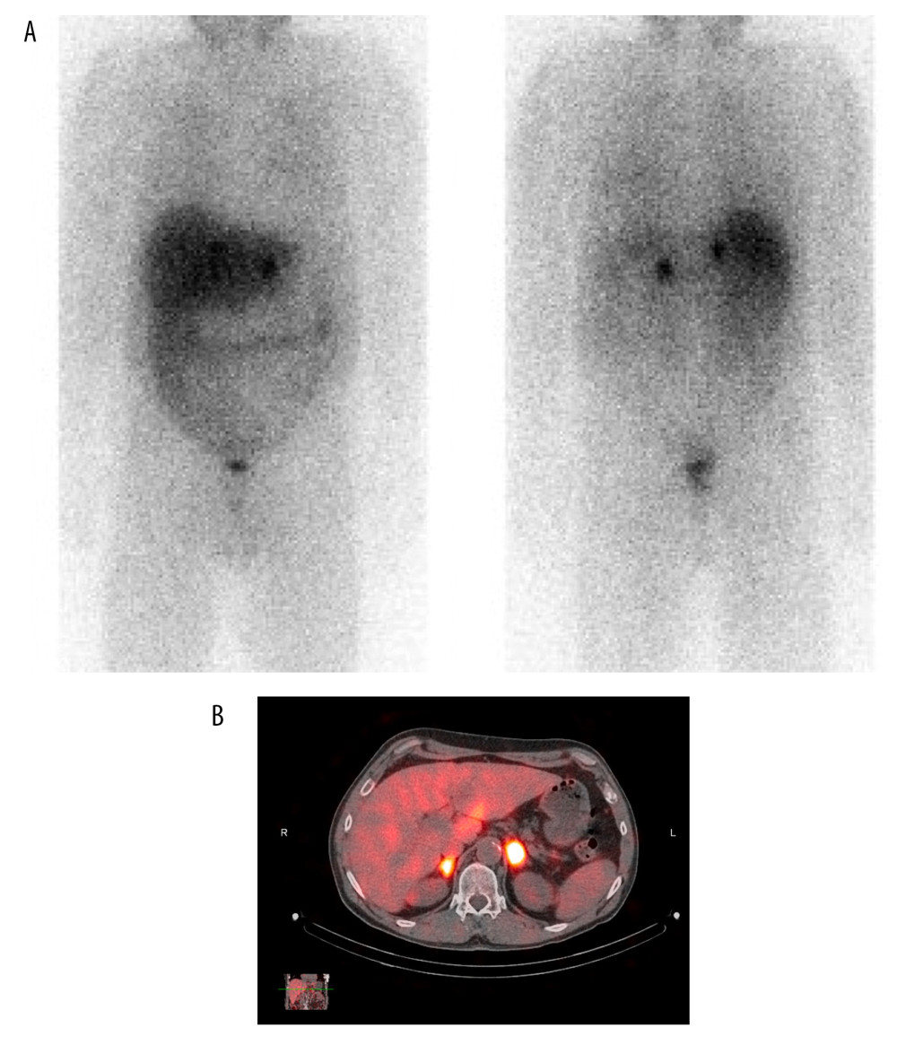 Patient’s tumor localization imaging (11/2010). (A) Sagittal view of the patient’s tumor localization imaging demonstrating bilateral adrenal nodules. (B) Coronal view, again demonstrating bilateral adrenal nodules with increased radiotracer uptake. These findings are compatible with pheochromocytomas. Evidence of metastatic disease was not identified on these images.