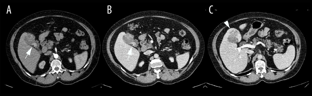 Preoperative CT scans: heterogenous and hypodense (head of arrow) lesion, measuring 4.0×3.9 cm, located under the projection of segment IV of the liver, without cleavage plane with the gallbladder (arrows). No signs of bile ducts dilation; A – arterial phase; B – portal phase; C – late phase.