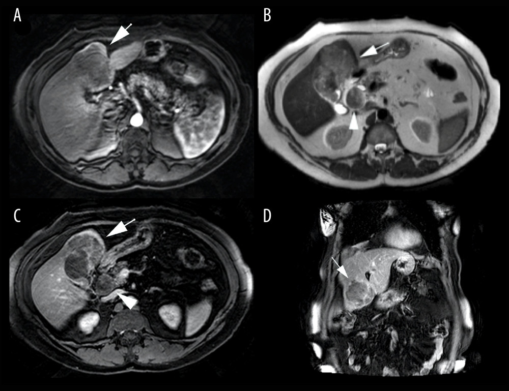 Preoperative MRI: expansive lesion (arrows) on the gallbladder site, with imprecise limits and heterogeneous signal in the T1- (A, C, D) and T2-weighted (B) sequences, with hypovascular contrast enhancement in all phases (arterial, portal and late phases), affecting segment IVb of the liver; and lymph node enlargement in the hepatic hilum (B – arrowhead).