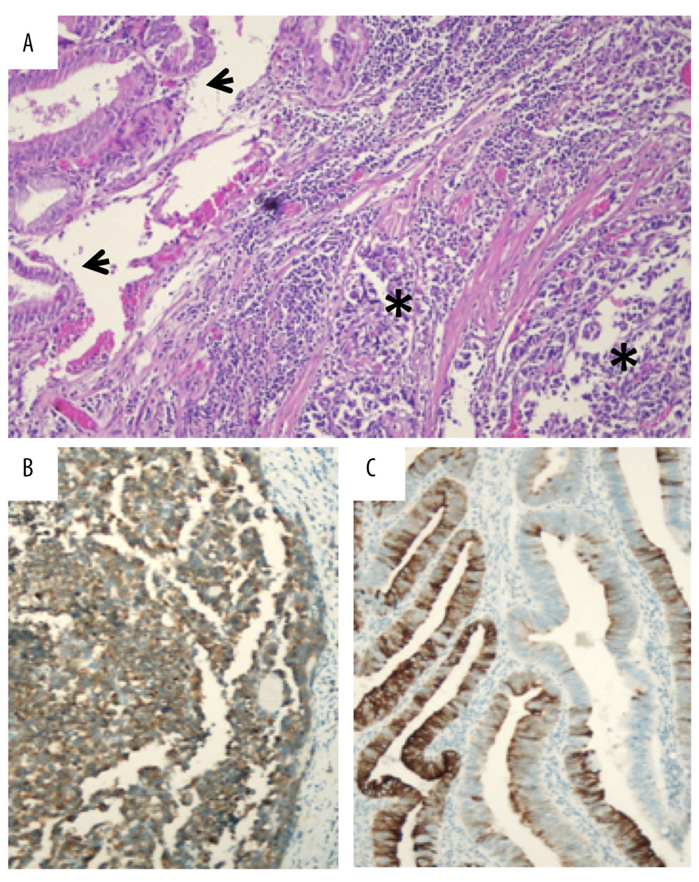 Mixed adenoneuroendocrine carcinoma of the gallbladder stained with Hematoxylin and Eosin (H&E): adenocarcinomatous (arrow) and neuroendocrine (*) components (A); immunohistochemical (IHC) staining for CgA in the neuroendocrine portion (B) and CK7 (SP52) in the adenocarcinomatous portion (C).