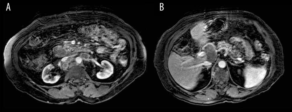 Postoperative MRI showing multiple retroperitoneal lymph nodes enlargements in para-aortic and precaval situation (A) and around the celiac trunk and hepatic artery (B).