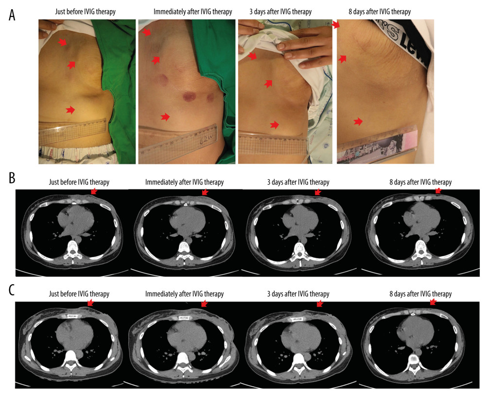 Effects of intravenous immunoglobulin (IVIG) therapy in Pfeifer-Weber-Christian disease (PWCD). (A) Change in skin nodules by IVIG therapy. Multiple crops of palpable masses on the left anterior chest decreased in size after IVIG therapy (before, immediately after, 3 days after, and 8 weeks after IVIG therapy). Chest deformities remained. The red arrows indicate masses. (B, C) Changes in computed tomography (CT) scan findings. The initial computed tomography (CT) scan findings were diffuse extensive infiltrative lesions involving the left anterior chest and abdominal wall, mainly involving the subcutaneous layer, with focal skin thickening, and probable lymphoma infiltrating subcutaneous fat was suggested with a probable diagnosis of cutaneous lymphoma as in the previous diagnoses in the other hospitals. On CT scan, the improvement in infiltrative multiple lesions on the left anterior chest began after 3 days. The lesions on the CT scan were much improved 8 weeks after IVIG therapy. Red arrows indicate masses. Figure B is the middle mass, and Figure C is the lower mass in Figure A.
