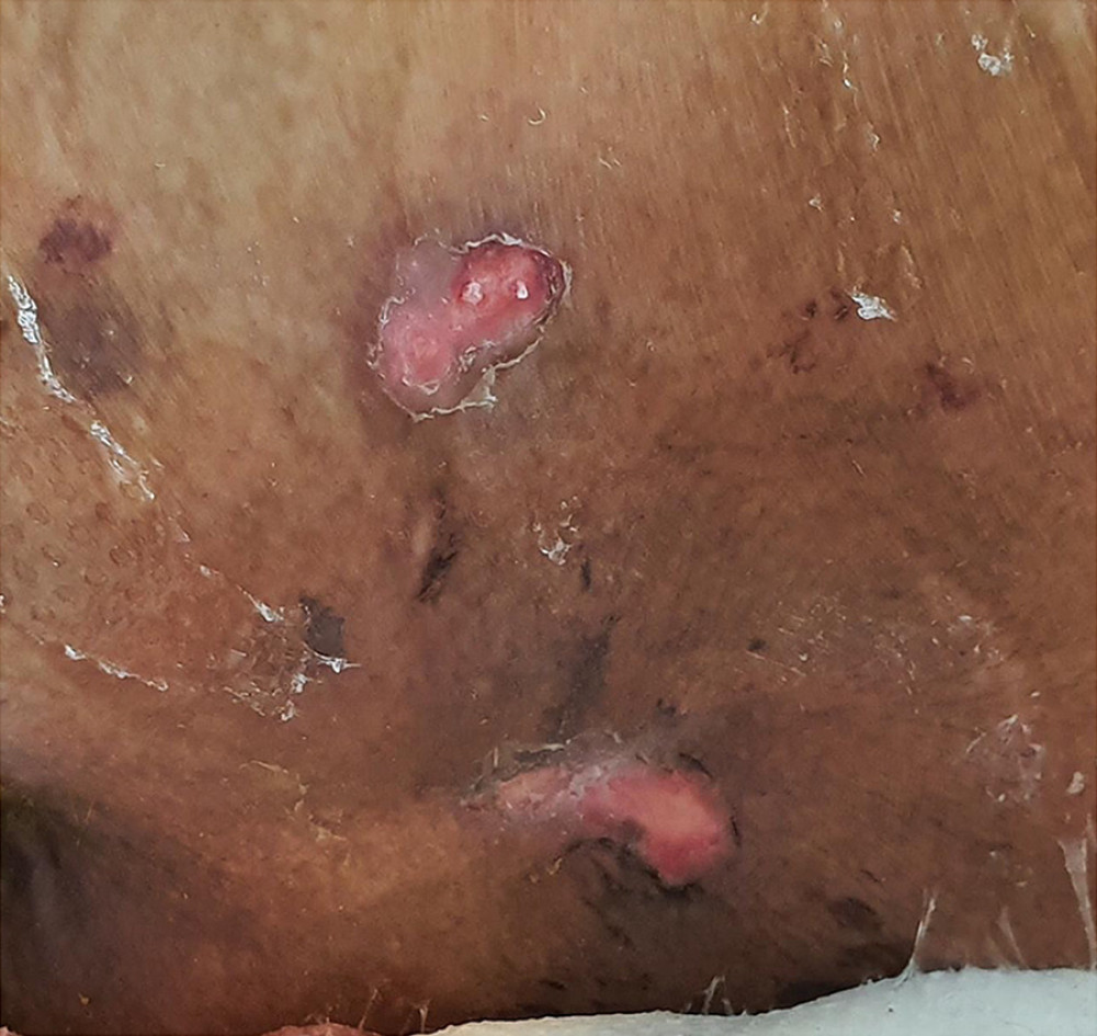 Stage 2 sacral ulcer without signs of an infection.