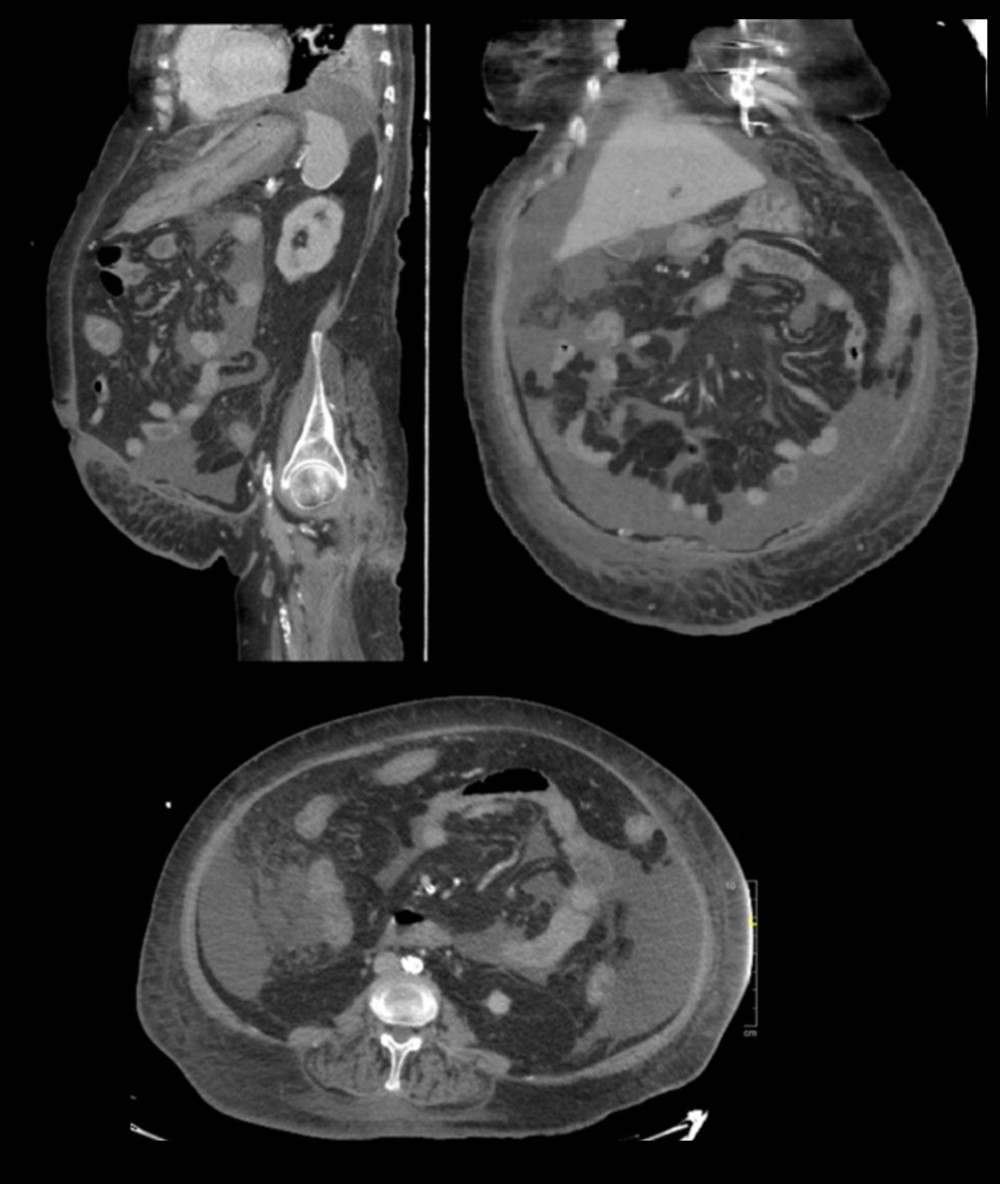 Abdominal and pelvis computed tomography scans showing circumferential wall thickening of the colon and rectum, prominent in the left transverse colon, and abdominopelvic free fluid with no free air.