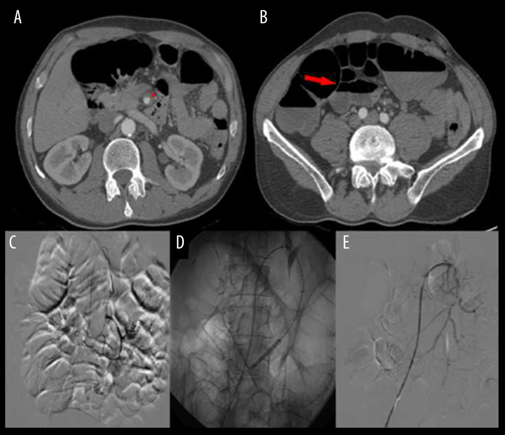 Case 1 involved a 54-year-old White man with a medical history of hypertension and a 2-day history of diffuse abdominal pain. An abdominal computed tomography (CT) scan showed SID-SMA (red signal) associated with “paper-thin wall” intestinal sign (arrow), dilatation of bowel lumen, and mesenteric fat stranding (A, B) Preprocedural selective angiography showed narrowed lumen of SMA and ileo-colic artery (arrow) with reduced distal perfusion (C). Fluoroscopy shows the deployed stent in SMA and balloon inflation during ileo-colic angioplasty (D). Postprocedural angiogram demonstrates the stent placement in SMA with better patency of the ileo-colic artery (E). SID – spontaneous isolated dissection; SMA – superior mesenteric artery.
