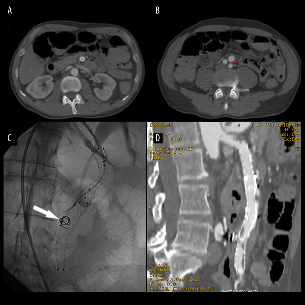 Case 1 involved a 54-year-old White man with a medical history of hypertension and a 2-day history of diffuse abdominal pain. An abdominal computed tomography (CT) scan revealed the presence of the previously employed stent for SID-SMA (A) and the recurrence of a dissection inferiorly with the aneurysm of false lumen (red signal) (B). Fluoroscopy showed additional stenting of the distal SMA with coils deployed in the aneurysm of the false lumen (white arrow) (C). A follow-up abdominal CT scan showed good patency of the stent lumen (D). SID – spontaneous isolated dissection; SMA – superior mesenteric artery.